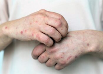 Dokter Internship 26 Tahun Meninggal karena Suspek Campak